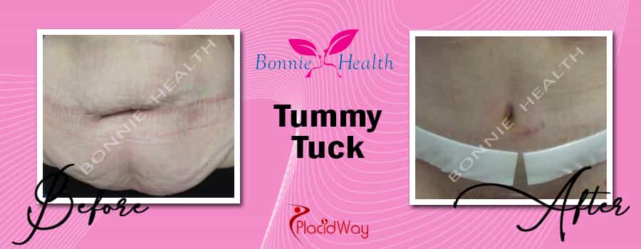 Before & After Tummy Tuck
